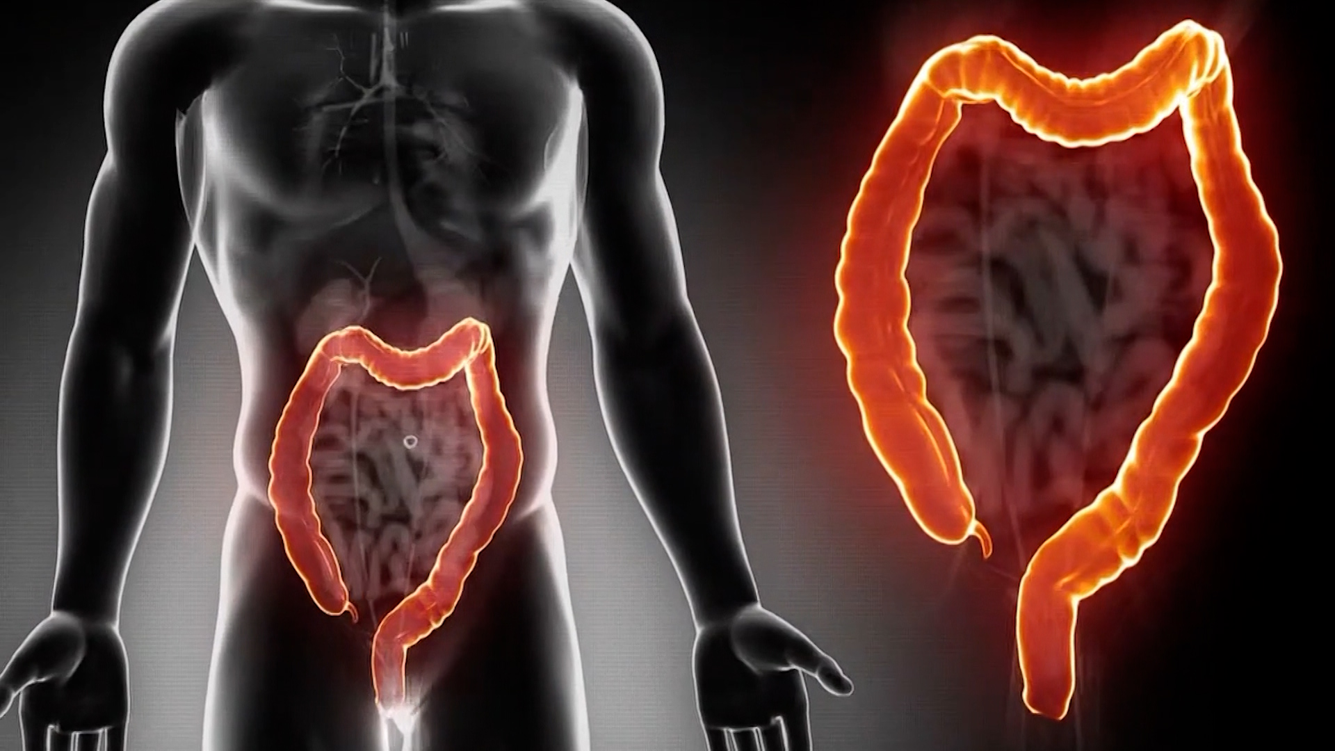 Health Check – Rise In Early-Onset Colorectal Cancer Raises Alarm In The Caribbean